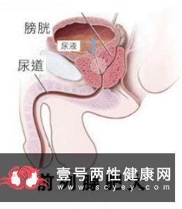 通过排尿可以检测出男性性功能障碍吗?