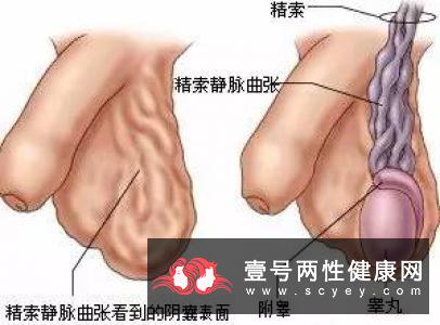 精液液化的原因导致男性不育的祸首