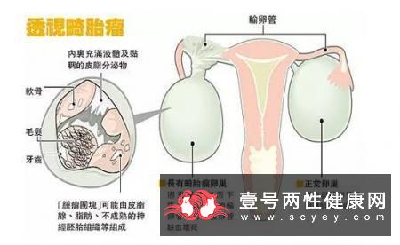 卵巢囊肿的合理疗法有什么