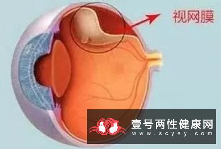 白内障是什么疾病？它又有哪些类型呢？