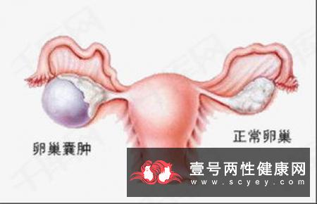 为什么会双侧卵巢多囊样改变?