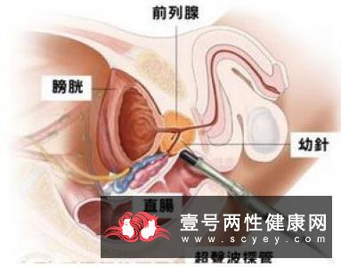 如何保护前列腺？要经常食用这些食物