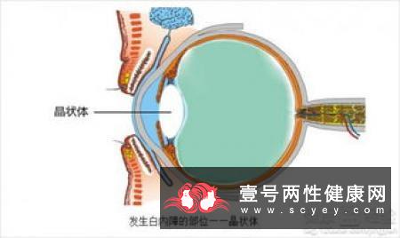 白内障患者日常护理办法有哪些呢？