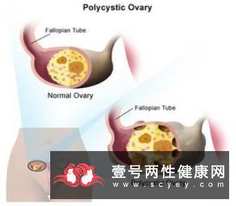 多囊卵巢综合病有什么症状
