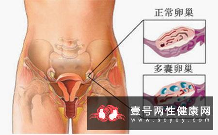 让女人得多囊卵巢的原因是什么