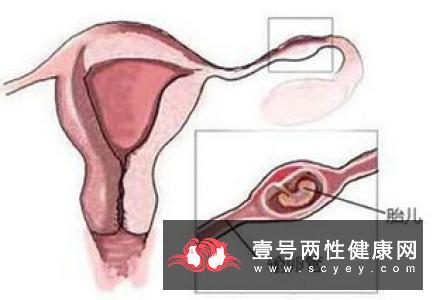 中医治疗卵巢破裂的方法有哪些