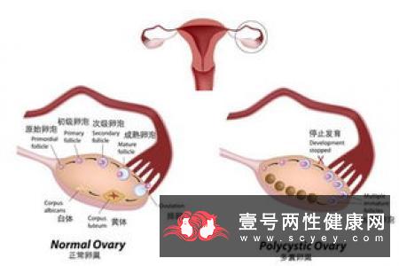 多囊卵巢综合病有什么症状