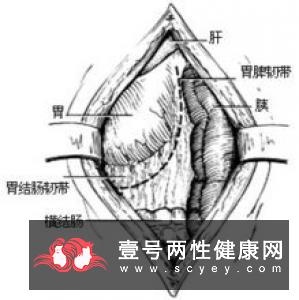 结扎手术的方法