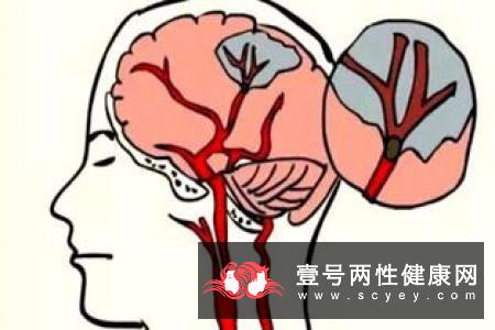 家中老人出现这些症状 警惕脑萎缩