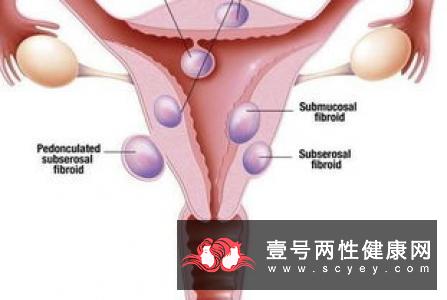 多囊卵巢排卵障碍是怎么回事