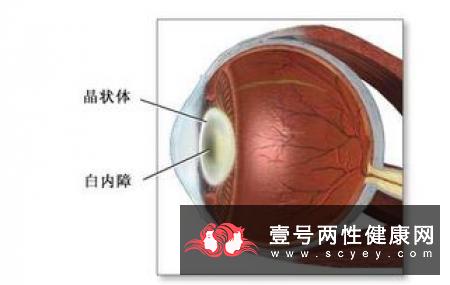 老年性白内障怎么治?