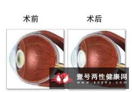 预防先天性白内障遗传办法