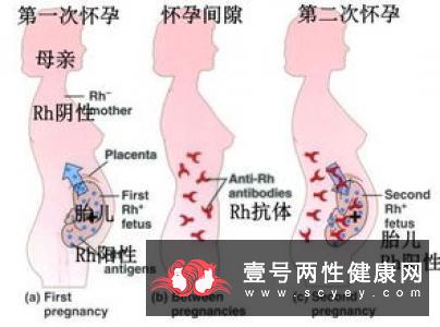 血型rh阳性与阴性的孕妇