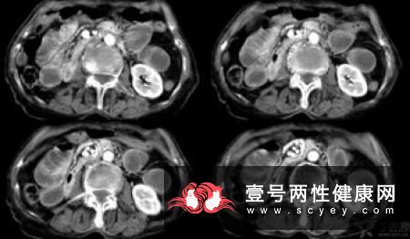 老年痴呆的病理和因素