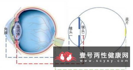 白内障术后有哪些注意事项呢